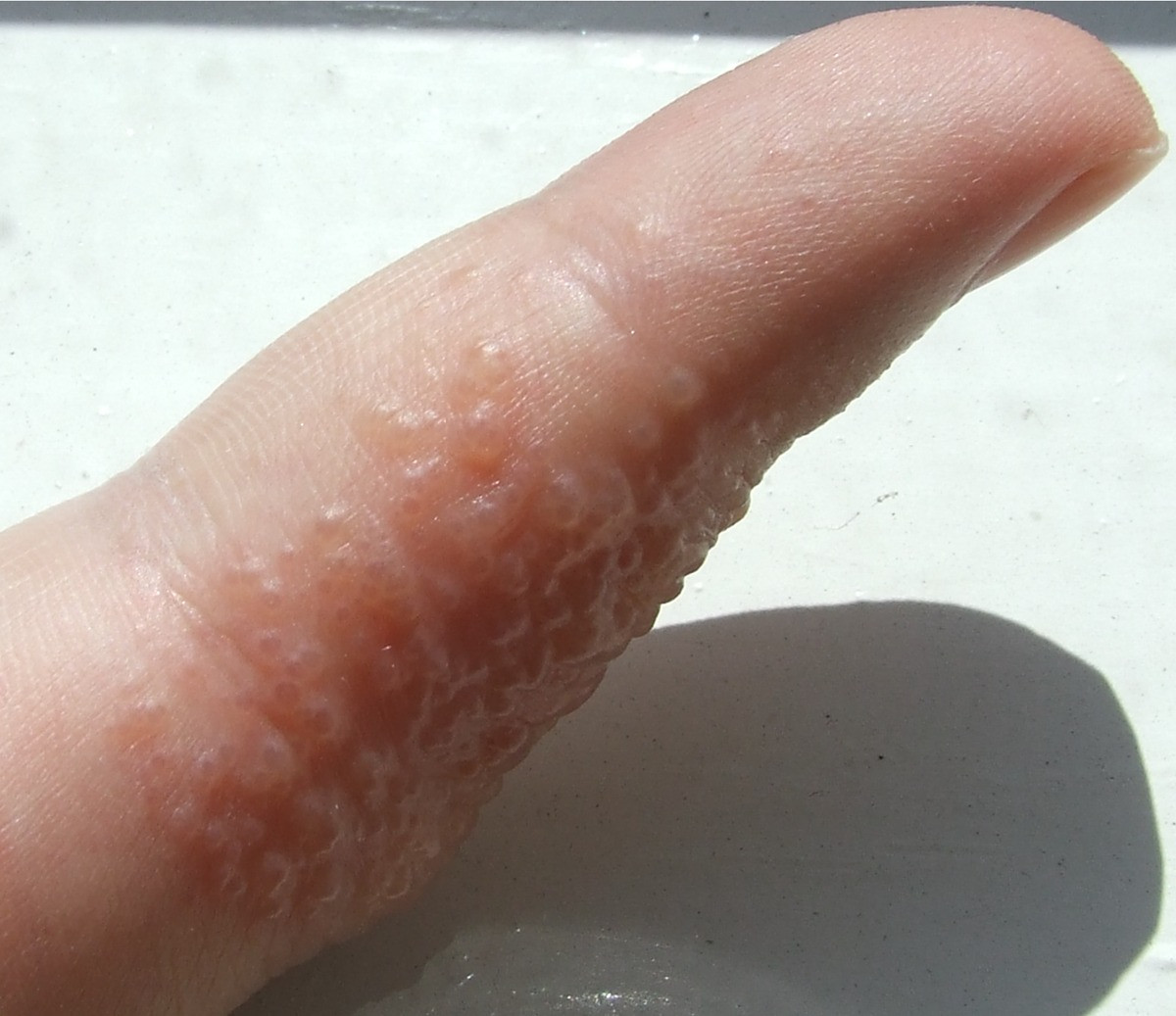 Dishidrosis